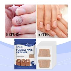 describe: Product Name: Fungus Nail Care Patch Size: 3.5*6.1cm/1.38*2.40" Product color: as shown in the picture Features: 1. Gentle repair and deep nourishment: It uses natural plant essence and mild formula to penetrate deeply into the nail bed, effectively repair damaged nails, promote healthy nail growth, while providing necessary nutrients and moisture to nails and restoring their natural luster. 2. Efficient cleaning, sterilization and anti-itching: Unique fungus-fighting ingredients can q Split Nail Repair, Split Nails, Secret Nails, Nail Problems, Efficient Cleaning, Spring Nail Designs, Nail Repair, Damaged Nails, Nail Bed