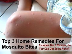 Top 3 Home Remedies for Mosquito Bites What Are Skin Tags, Remedies For Mosquito Bites, Bug Bites Remedies, Heath Tips, Home Remedies For Skin, Mosquito Bites, Mosquito Bite, Home Health Remedies, Holistic Remedies