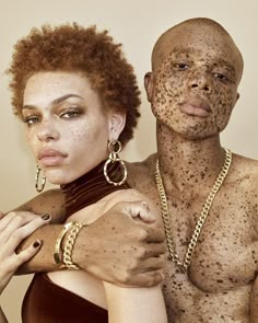 a man and woman with freckles on their body are posing for the camera