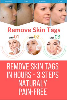 Skin Tags: Pain-Free Way to Remove Skin Tags in Hours 3 Steps Remove Skin Tags, Revenge Body, Cold Medicine, Home Remedy For Cough, Skin Natural Remedies, Skin Tags, Cold Sores Remedies, Weight Changes, Natural Sleep Remedies