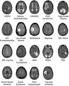 the different areas of the brain are labeled in black and white, including mris