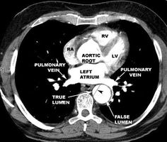 an x - ray shows the location of the heart and its major vessels in which it is