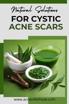 27 Best Tips For Clear Skin...Winning Ways To Stop Acne!! - The Beauty Deep Life Hormonal Cystic Acne, Get Rid Of Cystic Acne, Acne Diet Plan, Acne Prone Skin Care Routine, Painful Acne, Treating Cystic Acne, Acne Tips