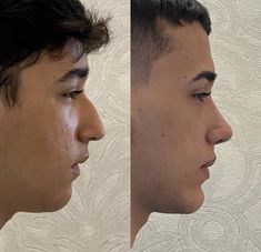 Aqualine Nose Men, Jaw Reduction Surgery, V Line Surgery, Upturned Nose, Plastic Surgery Fail, New Zealand Tattoo