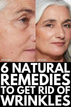 Discover the ultimate wrinkle remedies with this natural, fast-acting solution! Say goodbye to fine lines and wrinkles under eyes, around mouth, and on hands. Achieve a youthful glow quickly with this effective anti-aging remedy. #Wrinkle Remedies #NaturalSkincare #AntiAging #SkinCare #FastResults #Glowing Skin Get Rid Of Wrinkles, Healthy Remedies, Best Skin Care Routine, Skin Specialist, Saggy Skin