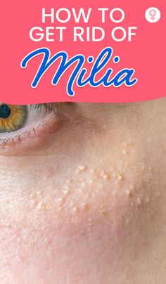 Milia is a skin condition that appears as small white spots on the skin that resemble rice grains. Learn how to get rid of milia quickly and effectively here. Wrinkle Remedies, Underarm Hair Removal, Dry Skin Remedies, Tongue Health, Face Wrinkles