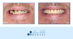 This #transformationtuesday is one of our very own denture patients! We love seeing such a big transformation and it is so amazing to see our patients be so confident in their smiles again <3  This is a photograph of Dr. Kian's Denture patient. Photographs are for informational purposes only, as individual treatment results will vary from patient to patient. Some patients may or may not be candidates for treatment. Call today for your consultation 780-849-2233. Transformation Tuesday