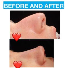 Bulbous Nose Rhinoplasty, Smaller Nose, Nose Rhinoplasty, Nose Lift, Bulbous Nose, Medi Spa, Neck Surgery