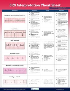 Use this EKG interpretation cheat sheet that summarizes all heart arrhythmias in an easy-to-understand fashion. Heart Rhythms Nursing, Arrhythmias Nursing Cheat Sheets, Paramedic Cheat Sheet, Nremt Study Cheat Sheets, Ekg Rhythms Cheat Sheets, Ekg Cheat Sheet, Easy Ekg Interpretation Cheat Sheets, Arrhythmias Notes, Ekg Interpretation Made Easy Cheat Sheets