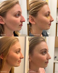 Nose Job Before And After Bump, Big Nose Rhinoplasty, Closed Rhinoplasty Before And After, Subtle Nose Job, Liquid Rhinoplasty Before And After, Rhinoplasty Before After, Nose Job Before And After, Irakli Nadar, Post Design Ideas