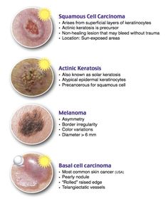 the different types of acne