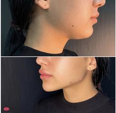 More Defined Jawline, Eye Lift Surgery, Defined Jawline, Lips Inspiration, Jaw Surgery