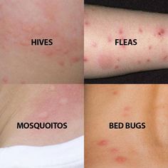 ~ Image of what different bites/skin conditions look like Bed Bug Bites Pictures, Bug Bite Itch, Itchy Bug Bites, Bug Bites Remedies, Bug Infestation, Rid Of Bed Bugs, Bed Bug Bites, Mosquito Bites, Bed Bug