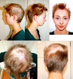 When Rebecca Brown twiddled and played with her hair for comfort as a child, never did she imagine it would develop into a full-blown… Bald Hairstyles For Women, Bald Hairstyles, Rebecca Brown, Female Pattern Baldness, Bald Patches, Fast Hair, Bald Spot, Bald Hair, Heart Break