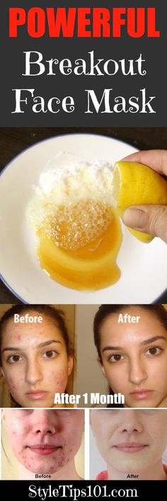 blemish fighting face mask Face Mask For Acne, Mask For Acne, Baking Soda Face, Acne Face Mask, Mask Ideas, Face Mask Recipe, Skin Mask, Face Acne, Acne Remedies