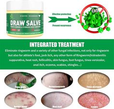 Drawing Salve Pilonidal Cyst. There are any references about Drawing Salve Pilonidal Cyst in here. you can look below. I hope this article about Drawing Salve Pilonidal Cyst can be useful for you. Please remember that this article is for reference purposes only. #drawing #salve #pilonidal #cyst