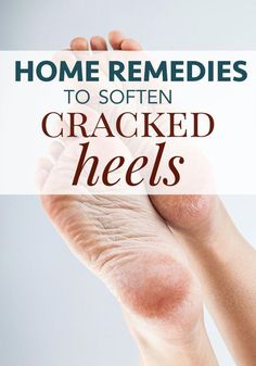 Do you suffer from dry, cracked heels even when it's not summer? Find out how to heal your feet naturally with these home remedies for cracked heels. Healing Dry Skin, Healing Tea, Whitening Face, Natural Health Tips, Skin Diseases, Natural Beauty Tips