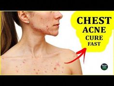 Best Acne Treatment at Home | Chest Acne / Body Acne Home Remedies | How To Treat Chest Acne Fast#acnetreatment #bodyacne #homeremedies🌟TreeActiv Acne Elimi... Get Rid Of Chest Acne, Chest Acne Remedies, Face Rejuvenation, Wrinkles Hands, Chest Acne, Night Skincare, Acne Overnight, Pimples Overnight, Natural Acne