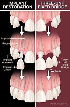 You can replace a single missing tooth with a single dental implant or a three tooth bridge. Implant Dental, Dental Assistant Study, Dental Insurance Plans, Dental Implants Cost, Dental Anatomy, Dental Fun