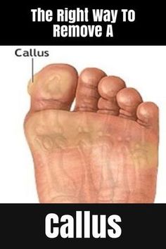 Callus Remover Diy, Best Callus Remover, Callous Remover, Nail Problems, Tongue Health, Callus Remover, Natural Cough Remedies, Callus Removal, Body Detox