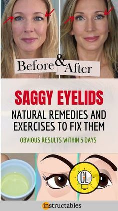 Droopy eyelid exercises to lift saggy eyes - ListPink Saggy Eyes, Saggy Eyelids, Sagging Eyelids, Droopy Eyelids, What Is Health, Healthy Book, Eyelid Lift, Health Plus