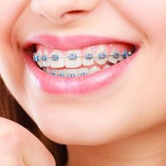 Damon Braces, Adult Braces, Braces Girls, Cute Braces, Clear Braces, Braces Colors, Pediatric Dental, Dental Braces, Metal Braces