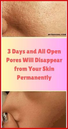 How to Get Rid of Warts, Moles, Age Spots and Skin Tag Using Natural Remedies