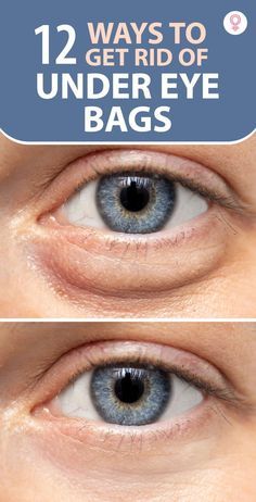 Undereye Bags Remedy, Get Rid Of Eye Bags, Rid Of Eye Bags, Eye Bag Remedies, Puffy Eyes Remedy, Bags Under Eyes, Skin Care Wrinkles, Under Eyes, Dark Circles Under Eyes