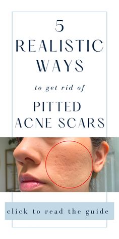 How to remove acne scars guide How To Get Rid Of Holes In Face, Buety Tips, Acne Holes, Micro Needling, Birthday Cat, Facial Treatments, Home Remedy For Cough