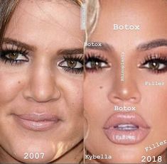 Celebrity Surgery, Botox Before And After, Botox Lips, Facial Contouring, Facial Aesthetics, Cosmetic Dermatology