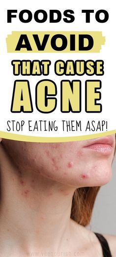 Breakfast For Clear Skin, Food For Acne Free Skin, Food To Avoid For Acne, Skin Clearing Tips, Foods That Cause Acne, Good For Clear Skin, Types Of Acne And How To Treat, How To Clear Acne, How To Clear Up Acne