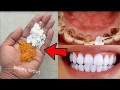 Jur pe Dumnezeu, nu te duci la dentist sa scoti tartrul, va cadea singur - YouTube Baking Soda Teeth, Natural Teeth Whitening Diy, Teeth Whitening Homemade, Get Whiter Teeth, Teeth Whitening Remedies, Teeth Whitening Diy, Natural Recipes, Teeth Bleaching, Yellow Teeth