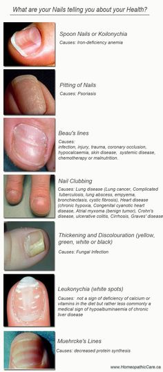 Nail Health Signs, Med Aesthetic, Forensic Medicine, Dermatology Nurse, Nail Disorders, Nail Conditions, Nail Problems, Health Chart