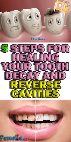 Reverse Cavities, Pasta Dental, Stronger Teeth, Oral Care Routine, Oral Health Care, Tooth Decay, Dental Implants, Oral Hygiene