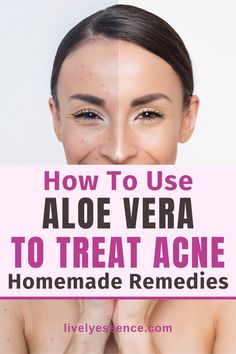 Pimples and acne are worse than you think! But don't worry, there's an easy solution. Aloe vera will get rid of them for good with its natural healing properties that reduce redness brought on by breakouts or pimples. #naturalremedies Essential Oils For Skin, How To Treat Acne