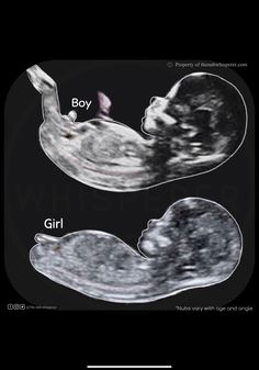 Baby Boy Ultrasound Pictures, Baby Ultrasound Pictures Ideas, Ultrasound Boy Or Girl, Boy Ultrasound Pictures, Boy Or Girl Prediction, Boy Ultrasound, Pregnancy Gender Prediction, Ultrasound Gender, Baby Ultrasound Pictures