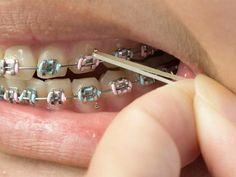 Braces Rubber Bands, Braces Smile, Teeth Aesthetic, Adult Braces, Getting Braces