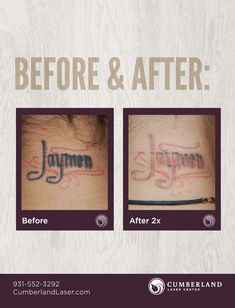 before and after tattoo removals