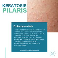 Keratosis Pilaris Graphic: How to fix the bumps on your skin. Keratosis pilaris (or also called follicular keratosis or sometimes “chicken skin”) is very common among people. Keratosis pilaris is those bumps you get on your skin. They are small, hard bumps. The color can be white, red, skin tone…colors can vary. It is harmless and non-irritating so far as symptoms go. It is usually on your thighs, upper arms, cheeks, and bum. Bumps On Skin, Bumps On Arms, Skin Tone Colors, Rough Bumpy Skin, Best Body Wash, Skin Bumps, Apricot Scrub, Dove Body Wash