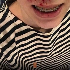 a woman with braces and blood on her face