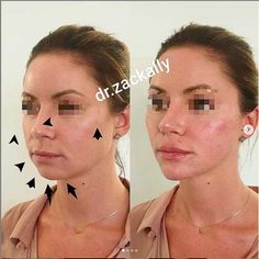 Better Jawline, Jawline Contour, Good Jawline, Skin Tightening Procedures, V Shape Face