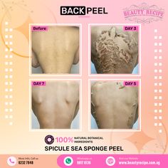 Spicule Sea Peel For Back Sea Sponge, Inner Glow, Unclog Pores, Side Effects, Dead Skin, Skin Cells, Natural Ingredients, Skin Care