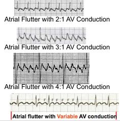 Atrial Flutter and Atrial Fibrillation Cardiovascular Technologist, Medicine School, Med Notes, Cardiac Nursing, Medical Laboratory Science, Atrial Fibrillation, Heart Rhythms