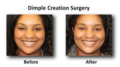 prasadcosmeticsurgery dimple | Dimple Creation Surgery Before and After Dimpleplasty Before And After, Nose Jobs, Rhinoplasty Nose Jobs, Thick Fashion, Workout Body, Reconstructive Surgery