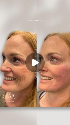 Courtney Moseley Charlotte Botox Filler Skincare Anti-Aging on Instagram: "You need to hear about this treatment!  I can’t give too much info, because the official release of the new skin booster filler won’t be until next year…but I can tell you it is going to be amazing for these stubborn accordion lines and lower “crows feet”.   This procedure gives immediate results with continued improvement over several weeks.   If you’re interested in booking this treatment, it’s under “skin booster” on my booking page.   Be sure to follow along for more aesthetic content ♥️ #Skinbooster #wrinklefix #smilelinesfiller #dermalfillercharlotte #physicianassistant #skinboosting #charlottenc" Botox For Crows Feet Before And After, Crows Feet Botox Before After, Natural Botox, Botox Before And After, Botox Filler, Give Too Much, Skin Booster, Botox Fillers, Smile Lines