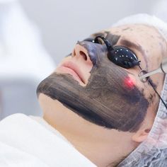 Carbon Peel, Laser Peel, Acne Laser, Forehead Acne, Peeling Facial, Scar Reduction, Laser Skin Resurfacing, Nd Yag Laser