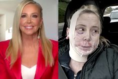 Facelift Recovery, Facial Before And After, Mini Face Lift, Mommy Makeover Surgery, Facelift Before And After, Bad Plastic Surgeries, Shannon Beador, Facelift Procedure, Face Lift Surgery