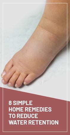 Fluid Retention Remedies, Swelling Remedies, Blood Sugar Tracker, Blood Sugar Solution, Swollen Legs, Blood Sugar Diet, Fluid Retention