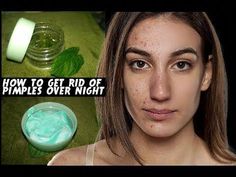 Almost every nightmare is having pimple on face and we all put our all efforts to get rid of these pimples and get back clear skin. In this video you will se... Pimple On Face, Natural Remedies For Acne, Pimples On Forehead, Small Pimples, Increase Height Exercise, Remedies For Acne