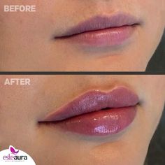 1ml Lip Filler, Dermal Fillers Lips, Fuller Lips Naturally, Plumper Lips, Lip Maximizer, Permanente Make-up, Face Fillers